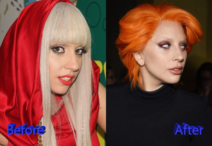 Lady Gaga Nose Job: A Multiple Plastic Surgery Procedures