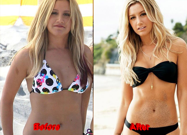Ashley Tisdale Plastic Surgery before after
