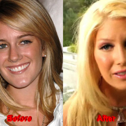 Heidi Montag Admitted To Have Undergone Plastic Surgery