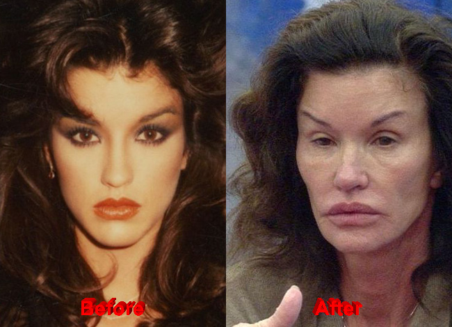 Janice Dickinson Plastic Surgery Horrible Results