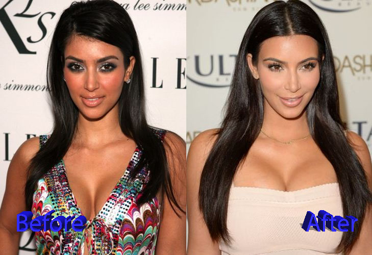 kim kardashian plastic surgery before and after photosphoto