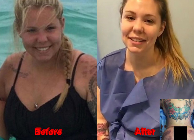 Kailyn Lowry And Her New Plastic Surgery