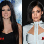 Kylie Jenner Before and After Plastic Surgery Transformation 150x150