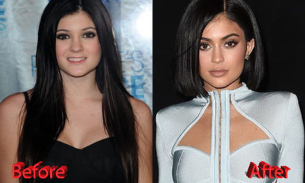 Kylie Jenner Plastic Surgery Facts, Rumors and News