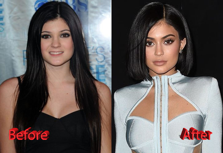 Kylie Jenner Plastic Surgery Facts, Rumors and News