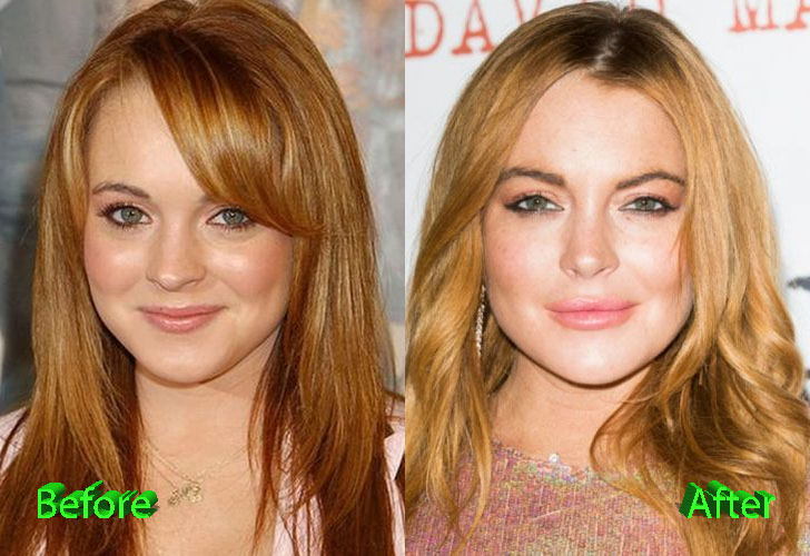 Lindsay Lohan Before and After Cosmetic Surgery.