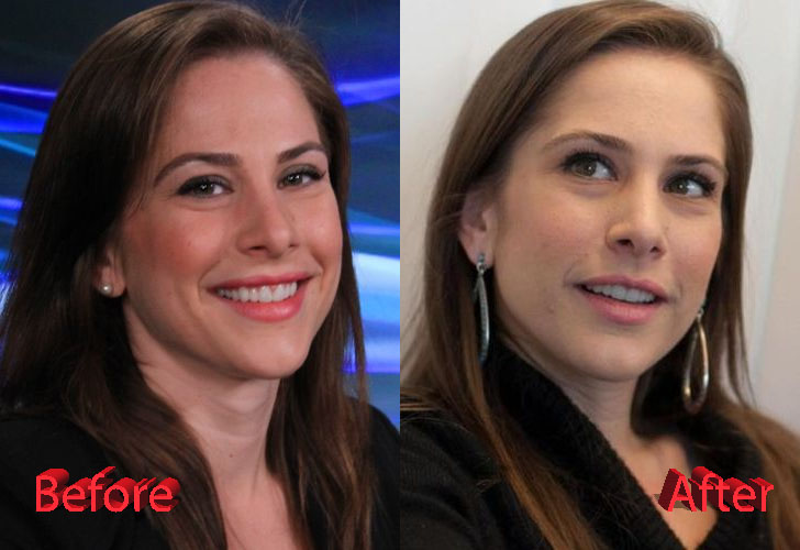 Ana Kasparian Nose Job: Before and After