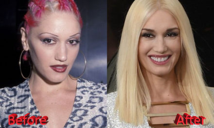 Gwen Stefani Plastic Surgery: Then and Now