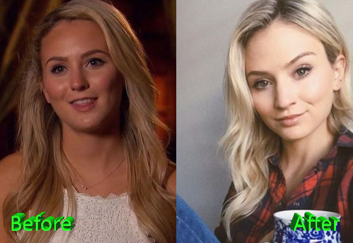 Lauren Bushnell Before and After Cosmetic Surgery 1