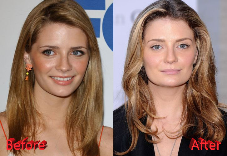 Mischa Barton Plastic Surgery Disaster