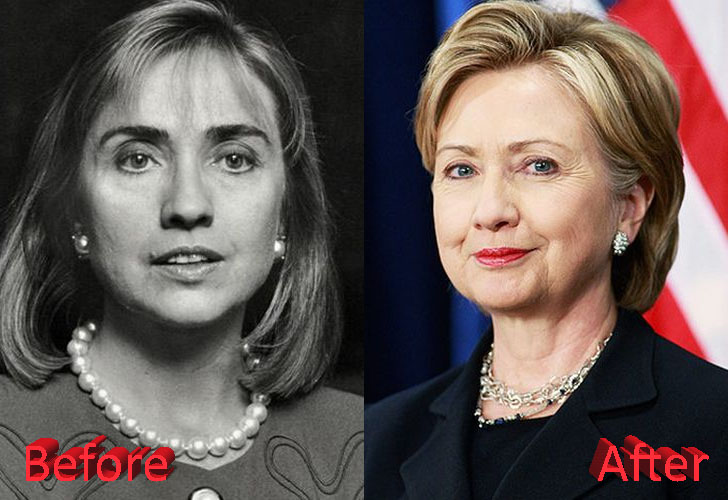 Hillary Clinton Plastic Surgery: A Presidential Boost