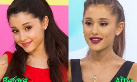 Ariana Grande Plastic Surgery: True or Just Rumours?