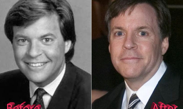 Bob Costas Before and After Plastic Surgery