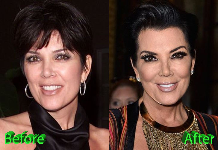 Kris Jenner Plastic Surgery: A Really Beautiful Granny