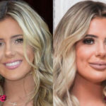 Brielle Biermann Before and After Cosmetic Surgery