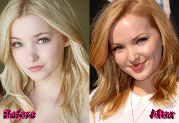 Dove Cameron Plastic Surgery: A Few Suspicious Changes