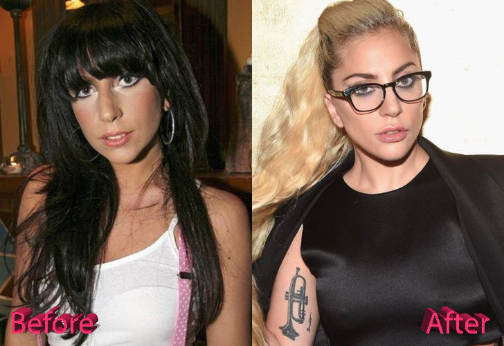 Lady Gaga Plastic Surgery: The Most Famous Chameleon