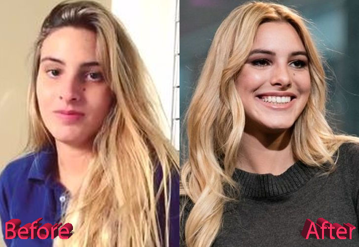 Lele Pons Nose Job: A Good Idea and A Good Result.