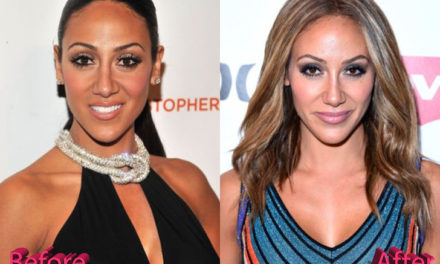 Melissa Gorga Plastic Surgery Before and After Review
