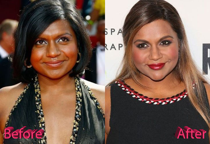 Mindy Kaling Plastic Surgery: A Project Done Well