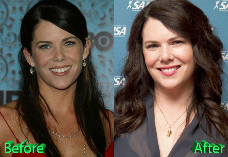 Lauren Graham Plastic Surgery: Less Is More