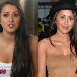 Marnie Simpson Before and After Nose Job Procedure 150x150