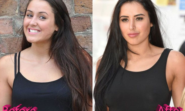 Marnie Simpson Nose Job: A Job Done Right