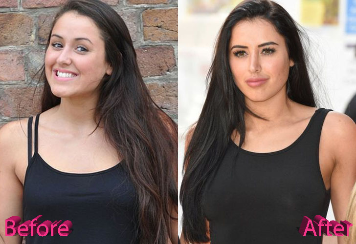 Marnie Simpson Nose Job: A Job Done Right.