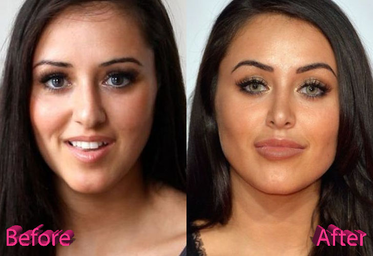 Marnie Simpson Nose Job Surgery Before and After.