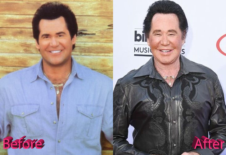 Wayne Newton Plastic Surgery: A Las Vegas Facelift