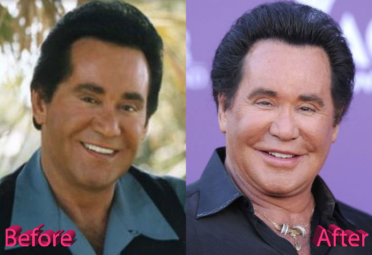 Wayne Newton Plastic Surgery A Las Vegas Facelift