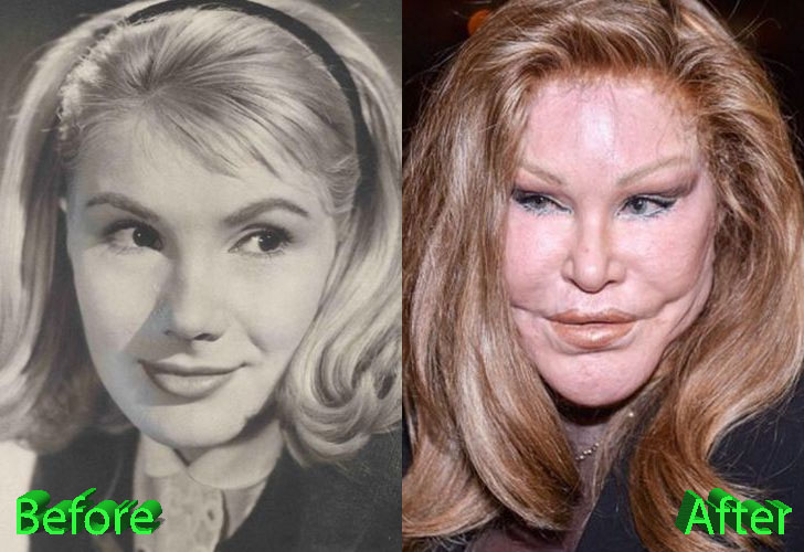 Catwoman Plastic Surgery is a good example of plastic surgery gone wrong. 