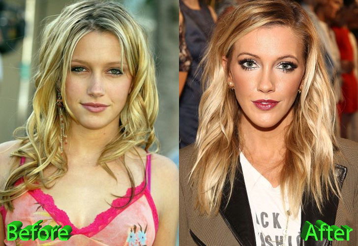 Katie Cassidy Plastic Surgery Before and After