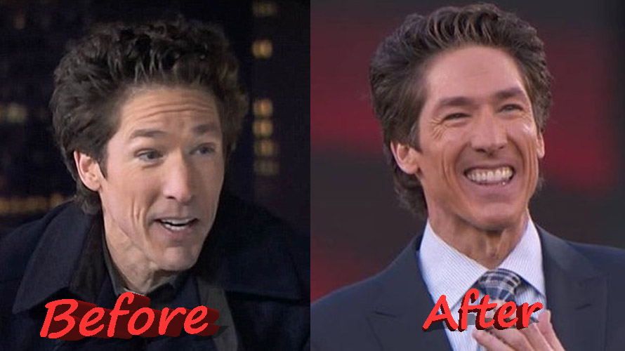 Is the Speculation About Joel Osteen Plastic Surgery True?