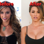 Ana Cheri Lip Implants and Nose Job Plastic Surgery Before and After