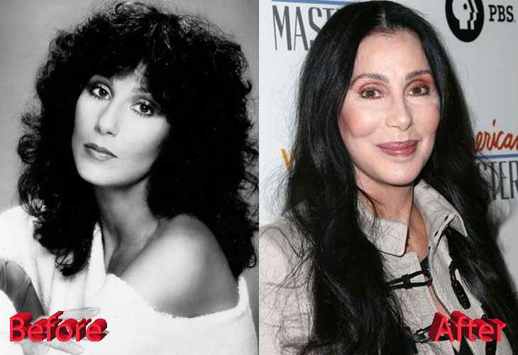 Cher Plastic Surgery : Just Too Much Of Procedures