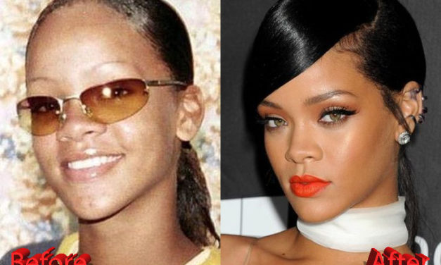 Rihanna Plastic Surgery : Rumors And Gossips About It