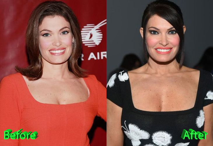 Kimberly Guilfoyle Plastic Surgery: A New Youth For News ...