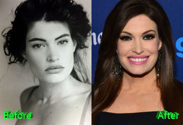 Beyond the Headlines: Kimberly Guilfoyle's Stunning Plastic Surgery Before and After Photos