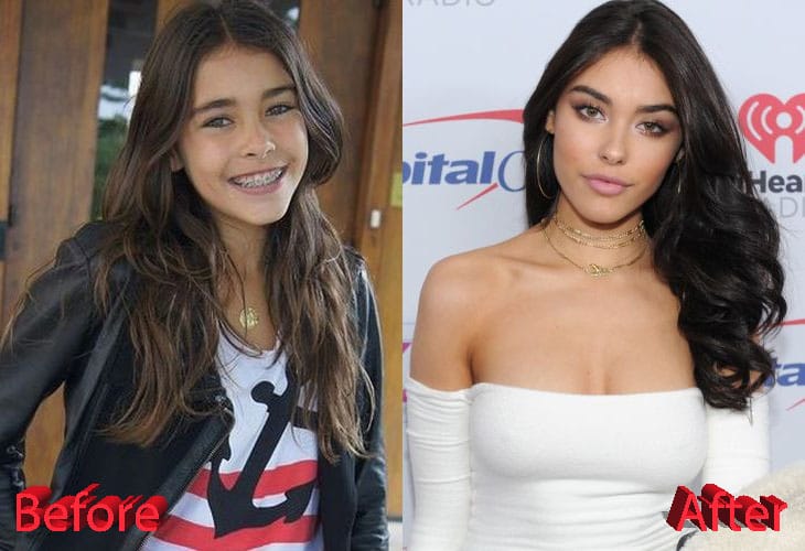 Madison Beer Before and After Cosmetic Surgery