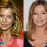 Cheryl Ladd Before and After Cosmetic Surgery