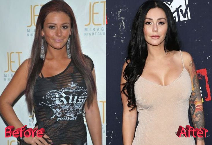 Jwoww Before and After Cosmetic Surgery. 