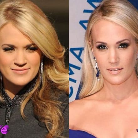 Carrie Underwood Plastic Surgery: A Beauty After the Accident