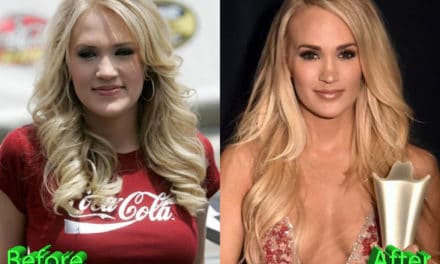 Carrie Underwood Plastic Surgery: A Beauty After the Accident