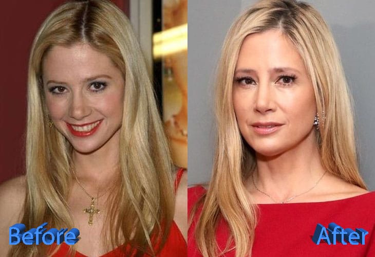 Mira Sorvino Plastic Surgery: Rumors and Gossips About It