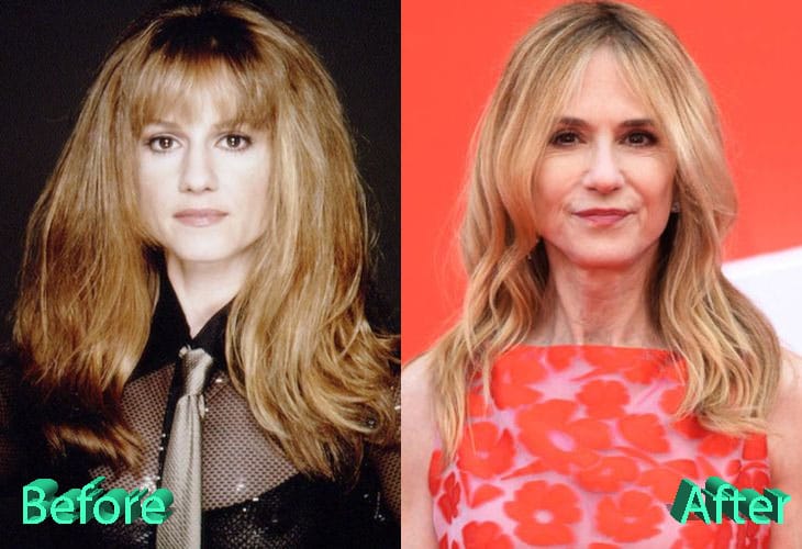Holly Hunter Before and After Cosmetic Surgery