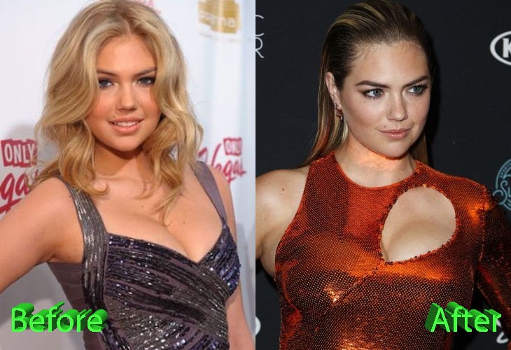 Kate Upton Before and After Plastic Surgery