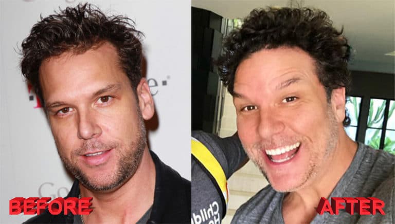 Dane Cook Plastic Surgery - Before and After Photos - Celebrity Plastic Surgery
