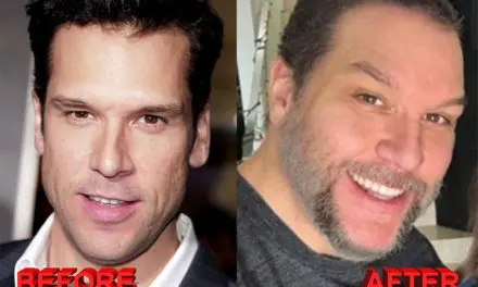 Dane Cook Plastic Surgery – Before and After Photos
